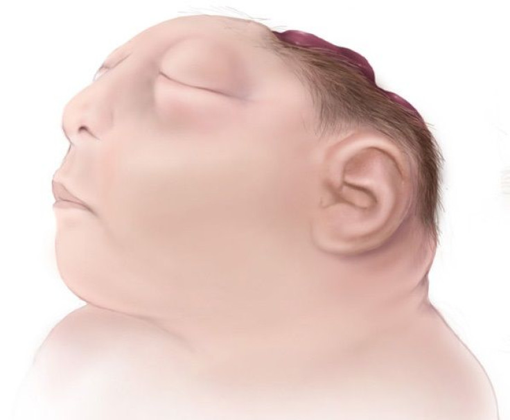 anencephaly