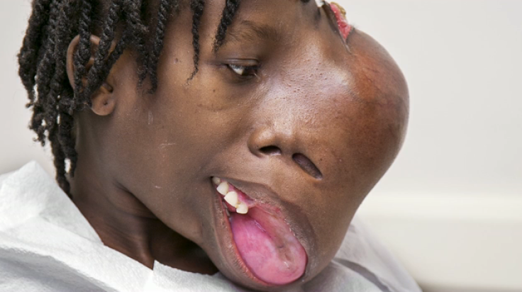 Haitian teen with facial tumor
