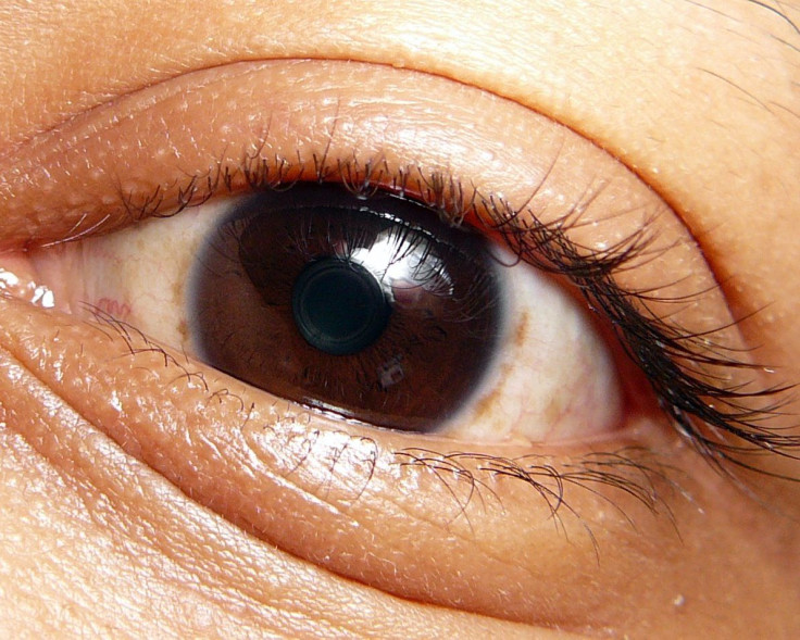 researchers-find-risk-factors-under-eye-bags-its-not-just-age