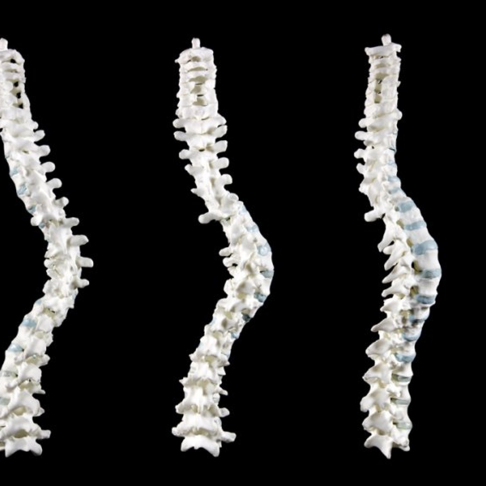 Richard Iii Skeleton Scoliosis