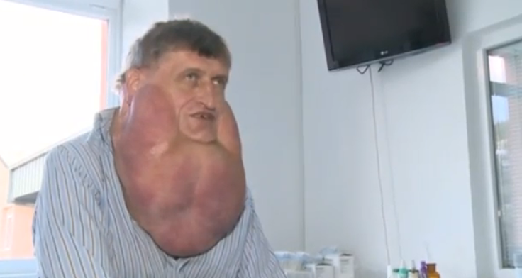 Slovakian man gets 13-pound facial tumor removed