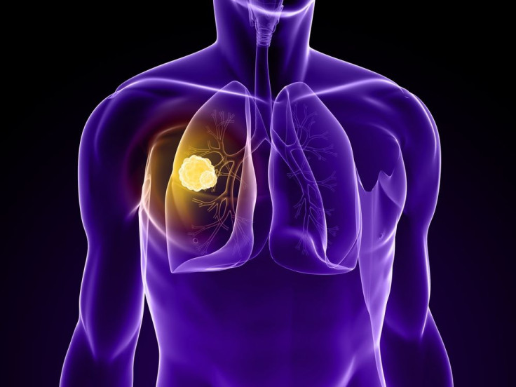 Experimental Drug Gives Hope To Lung Cancer Patients