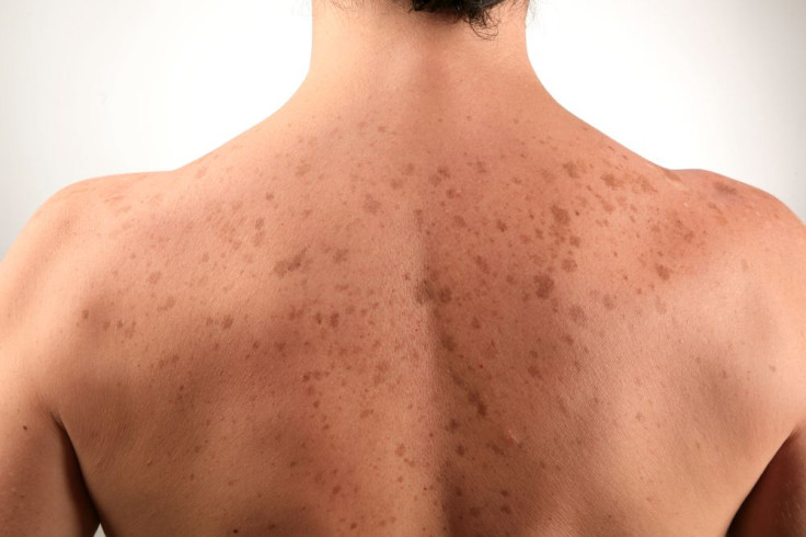 Birth Marks/Moles/Beauty Marks