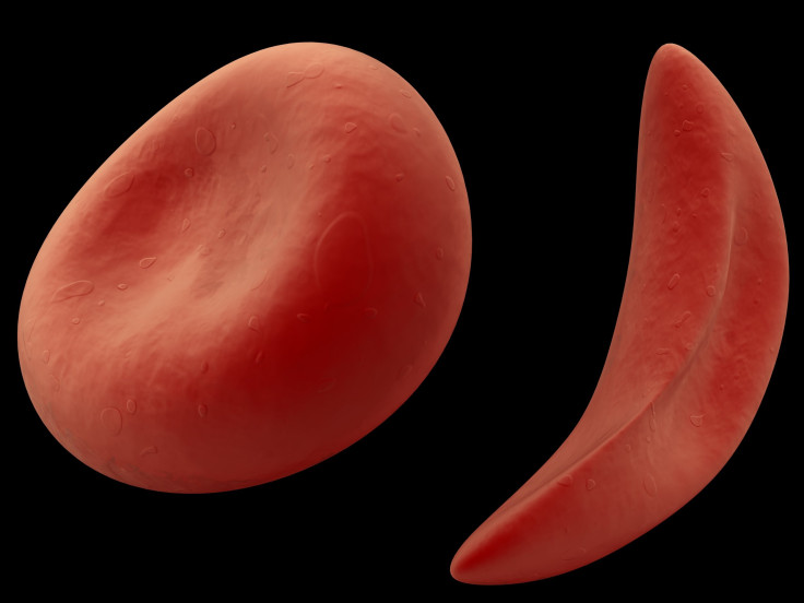 sickle cell disease