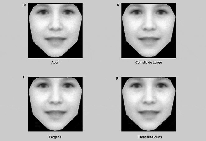 Rare Genetic Disorders Could Be Diagnosed With Facial Recognition ...