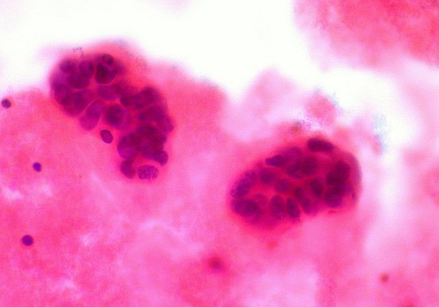 breast cancer