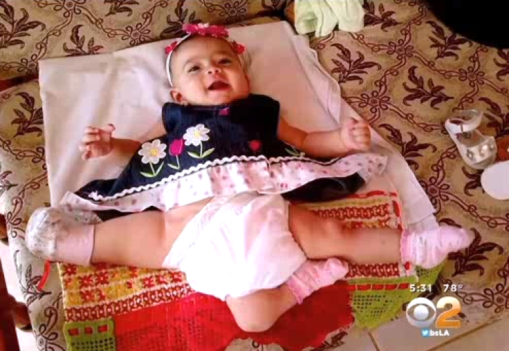 Girl with three legs set to have corrective surgery
