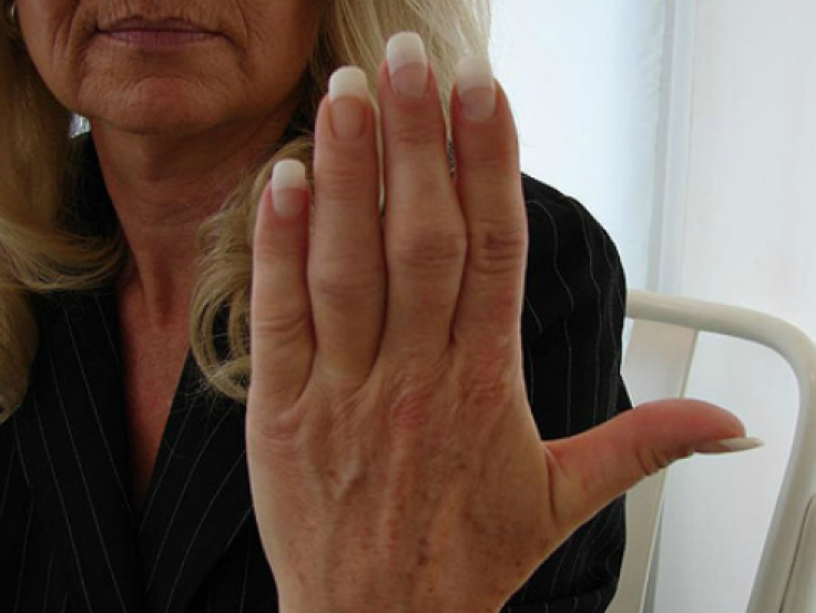 prosthetic-finger