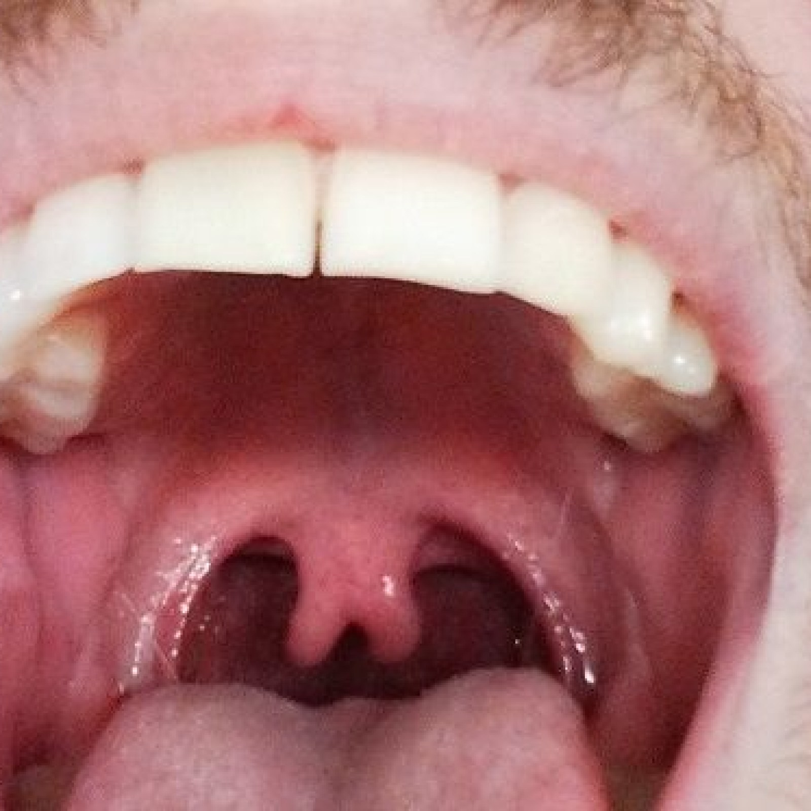 Normal Uvula Variations Healthy Uvula Two