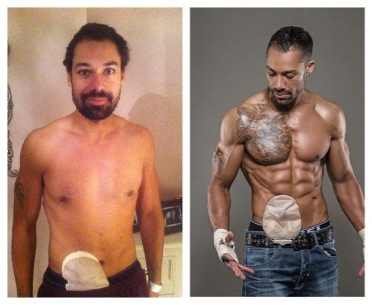 British Bodybuilder's Colostomy Bag Brings Him No Shame