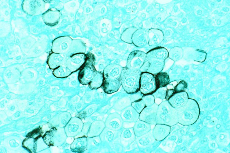 pancreatic-cancer-cells