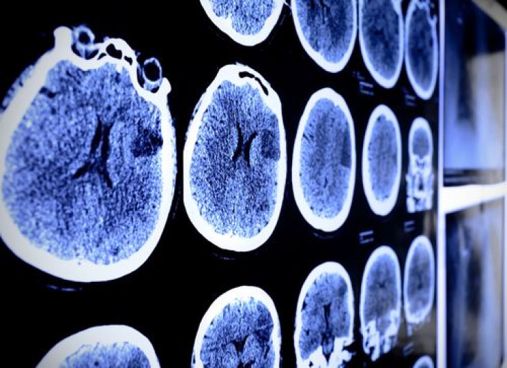 Stroke Sufferers May Have Future Treatmet Thanks To Stem Cells