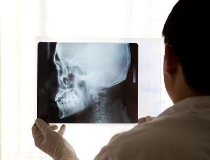 craniomaxillofacial bone defects