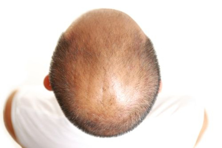 Treatment For Severe Baldness May Be On The Horizon