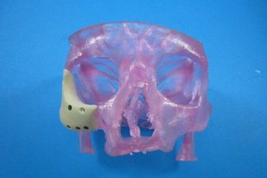 With the help of 3D printers, doctors can now produce an FDA-cleared replica of a patient's missing skull or jawbone.