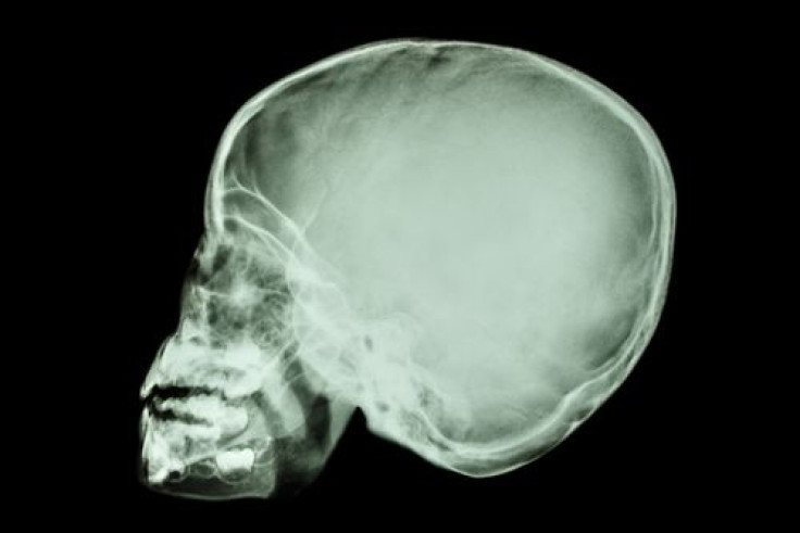 X-ray of child's skull