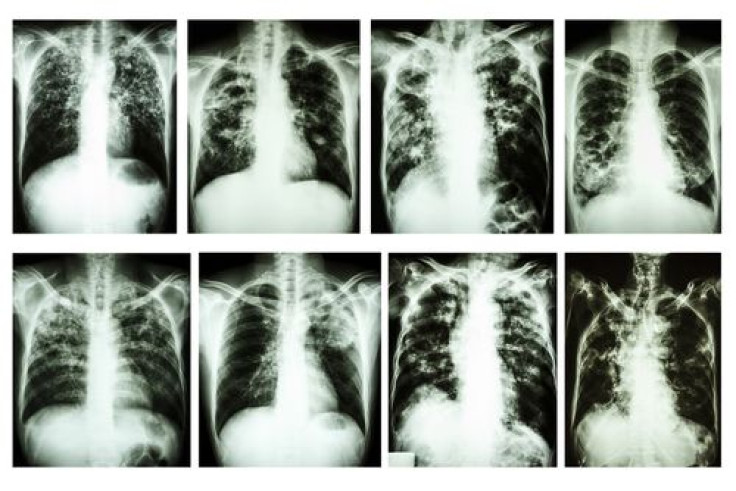 Researchers Take A Closer Look Into Tuberculosis