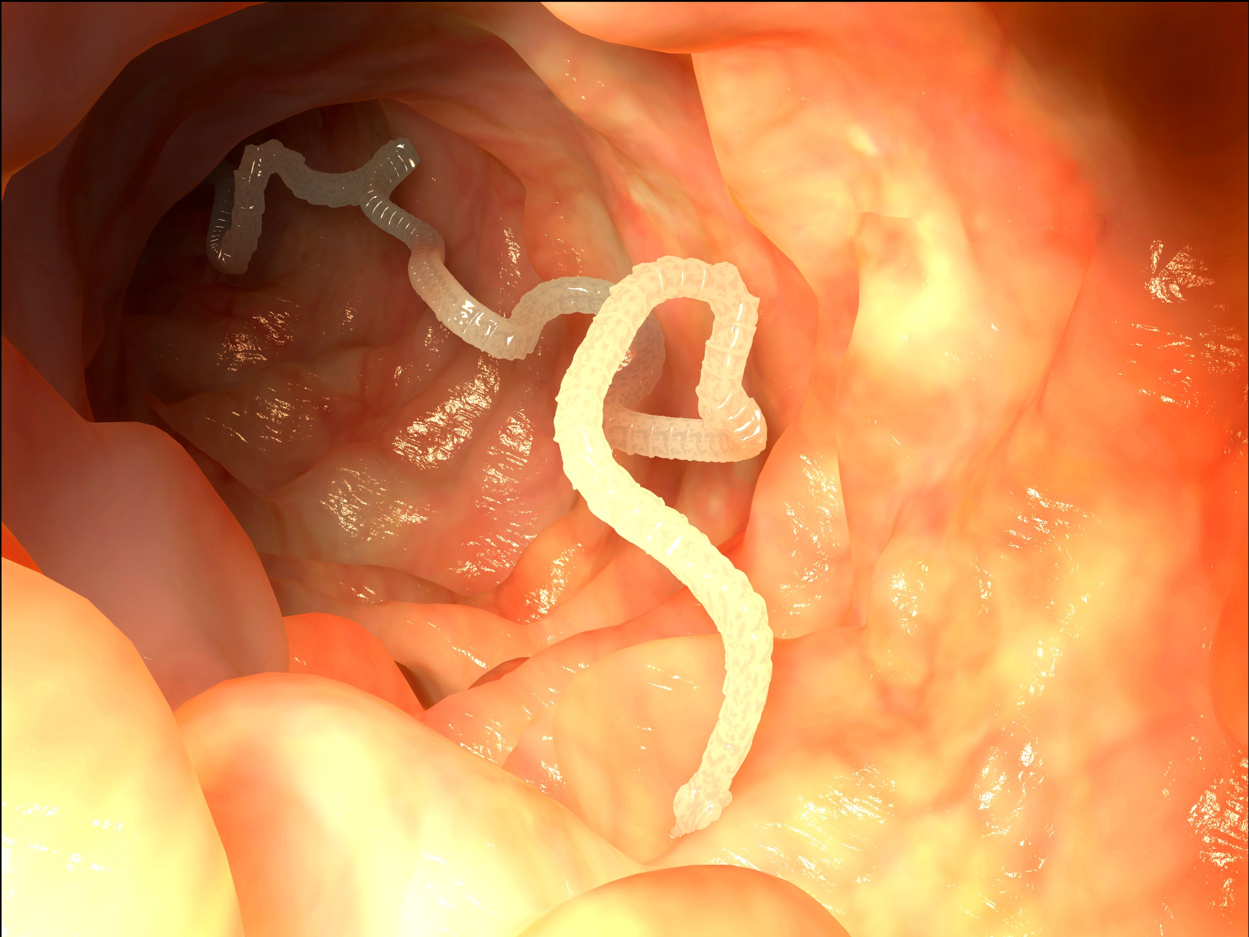 Tapeworm Weight Loss Pills Hospitalize Teen Girl After Mother s