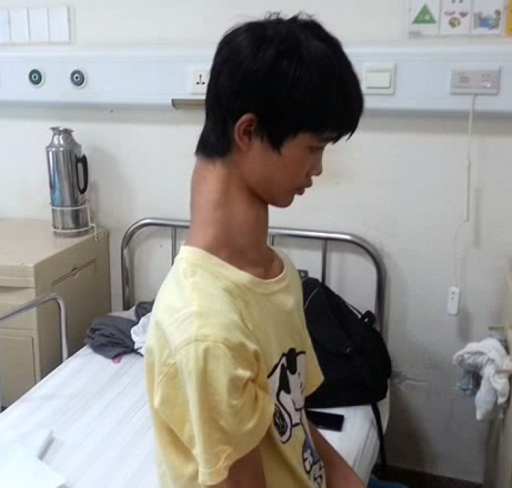 Chinese boy to get corrective surgery for super long neck