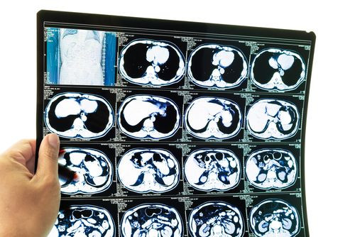 MRI
