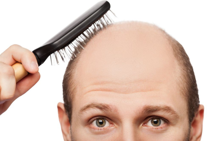 Male Pattern Baldness