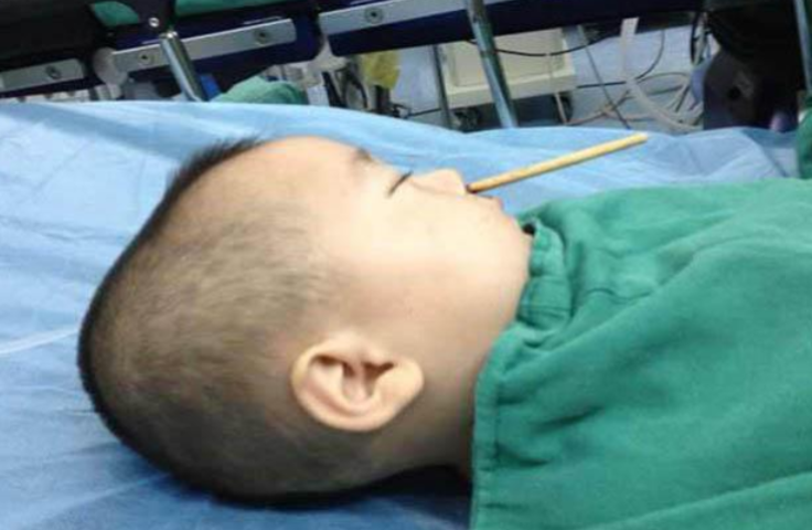 Toddler rams chopstick up nose and into brain