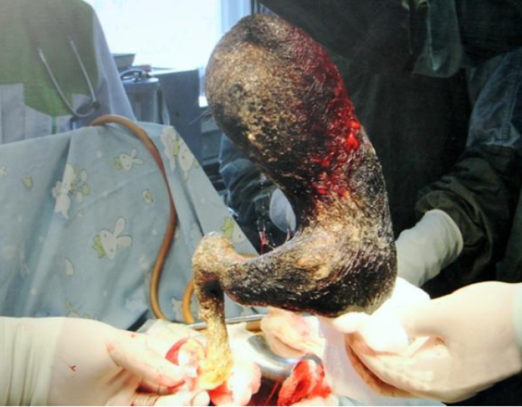 9-Pound hairball removed from girl's stomach