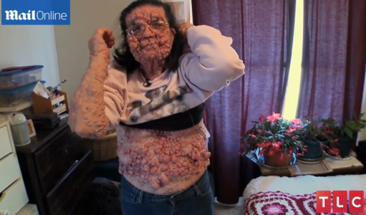 Grandma left "bubble" benign tumors on face and body