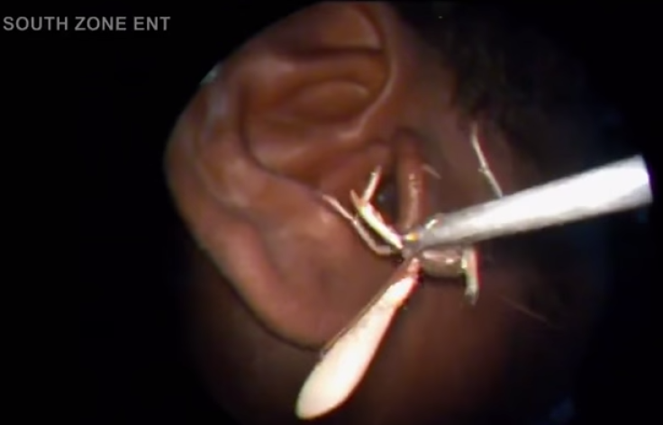 Doctors remove 3-inch live cricket from man's ear