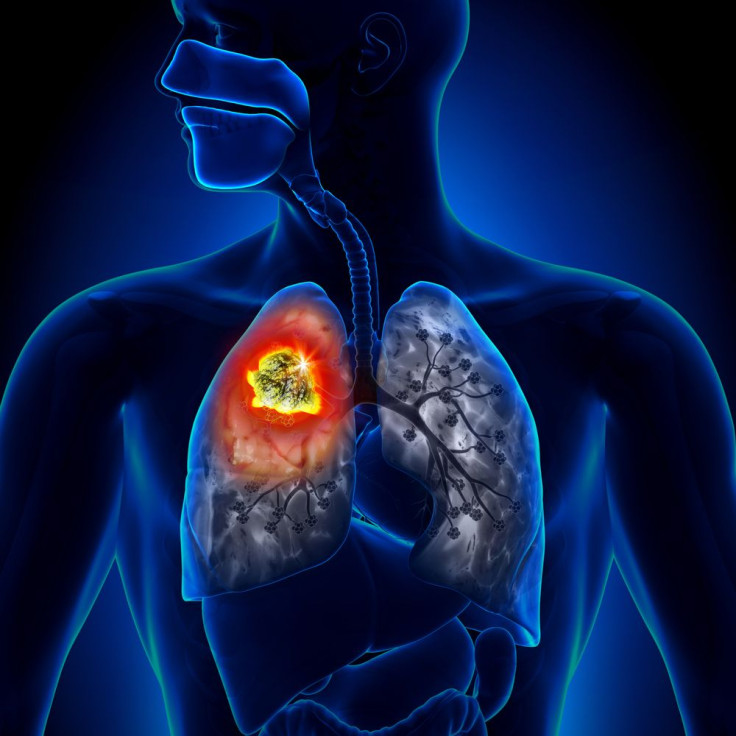 Lung Cancer 