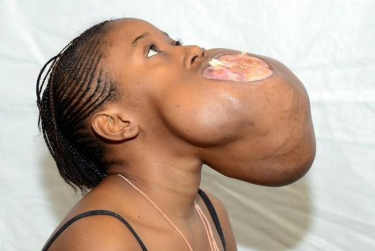 Teen gets football-sized facial tumor removed