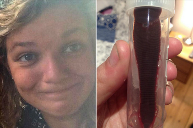 Woman finds 3-inch leech living up nose for a month