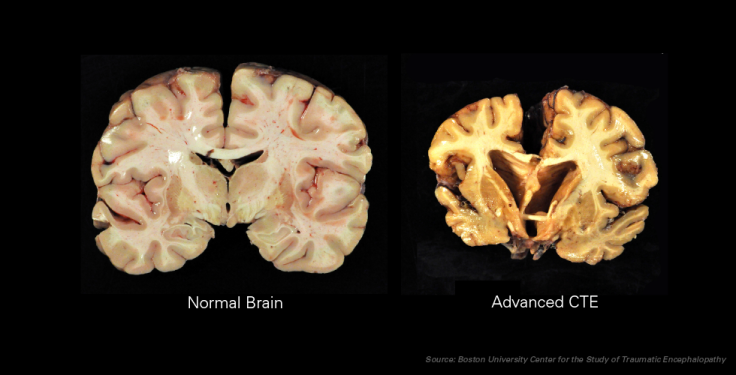 ctebrain