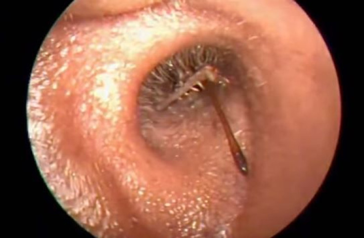 Live 3-inch long cricket inside man's ear