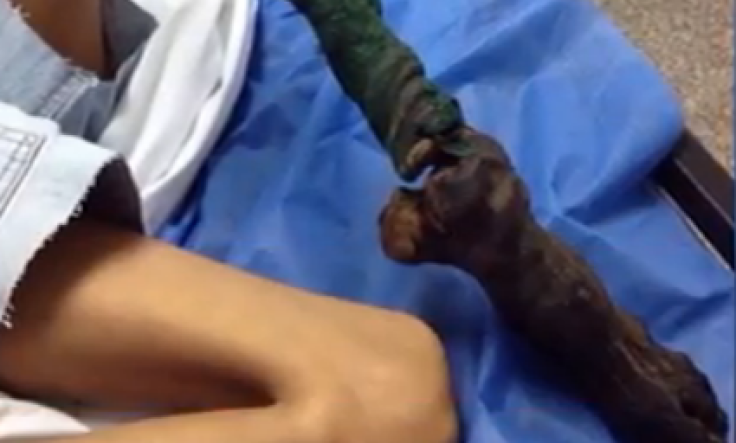 Snake bite leaves girl with 'black stick' leg and broken elbow