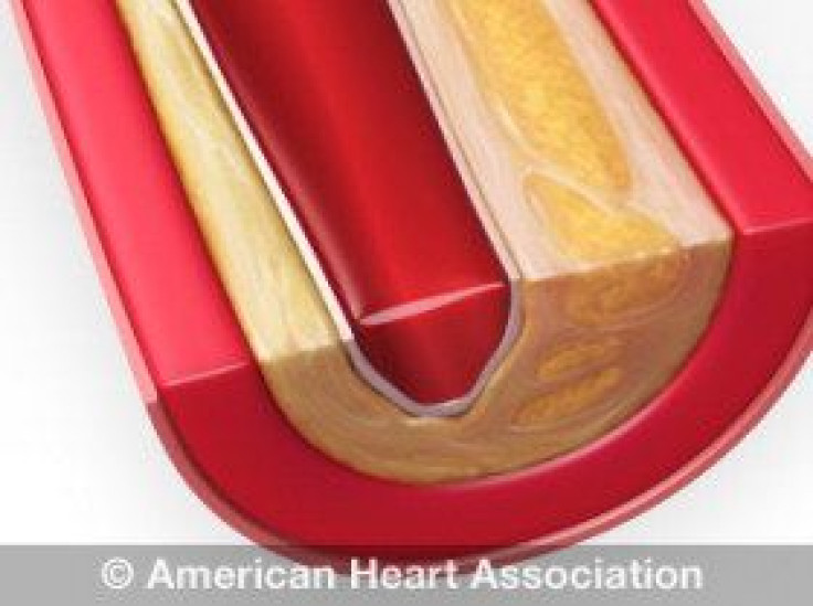Plaque Buildup In Arteries, American Heart Association