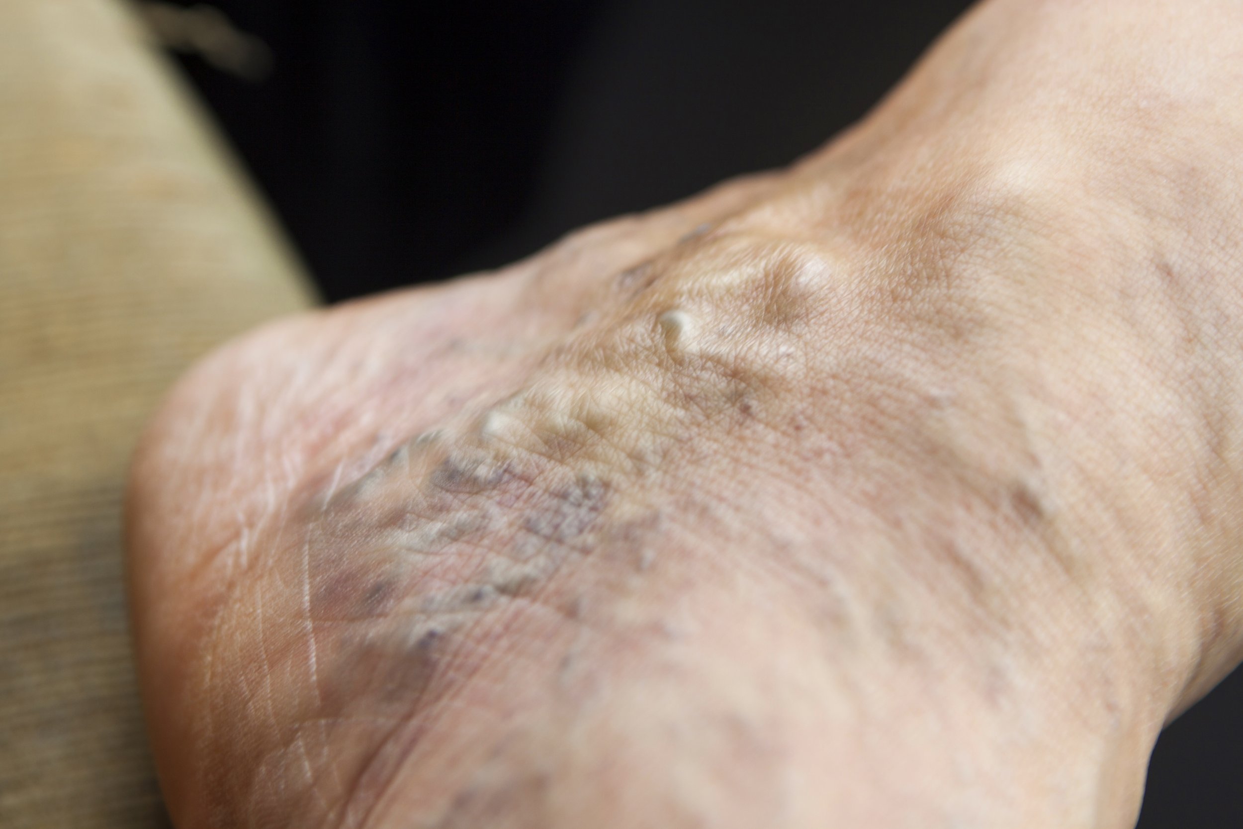 Varicose Veins From Sitting Cross Legged Plus Other Potential Causes