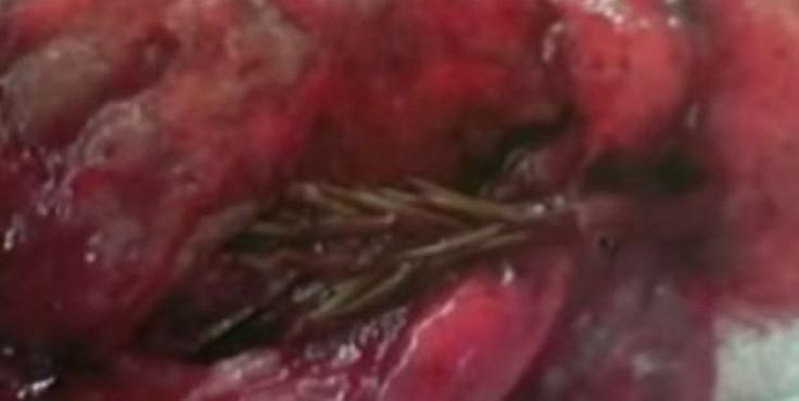 Sprouting fir tree found in man's lung