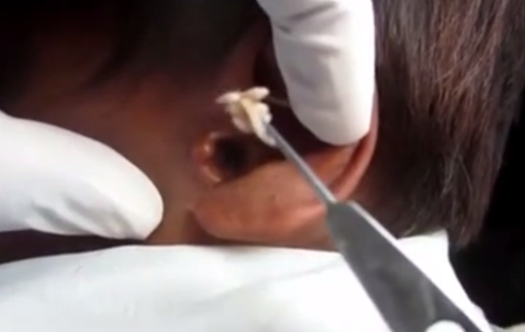 White maggot removed from man's ear