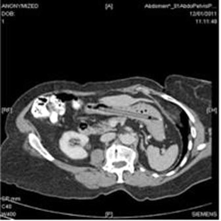 X-ray of 25-year-old pen in stomach