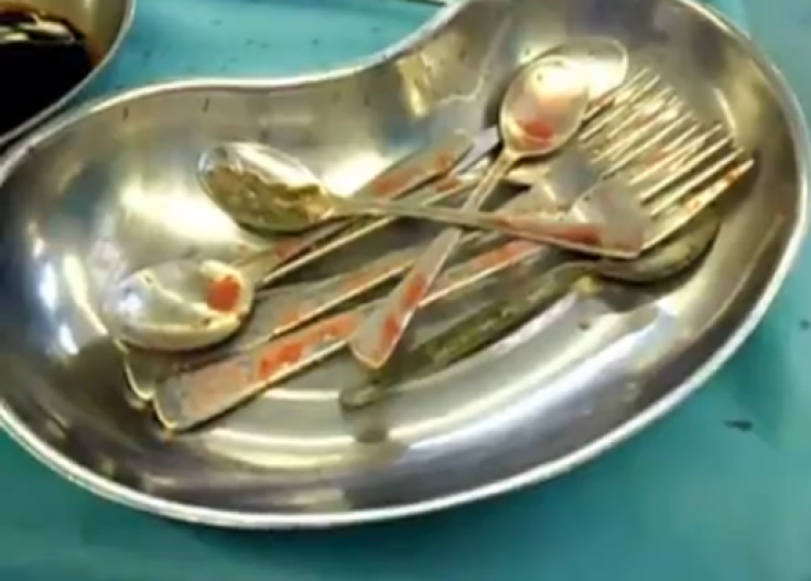 Spoons and forks removed from woman's stomach