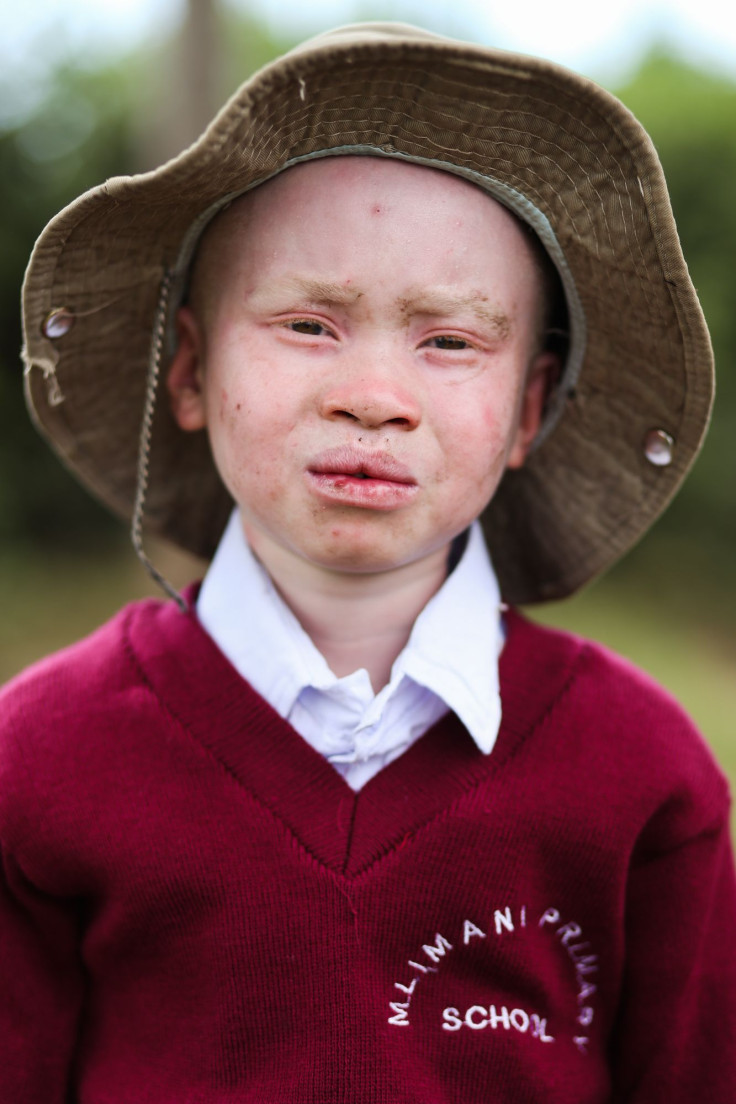 Albino child