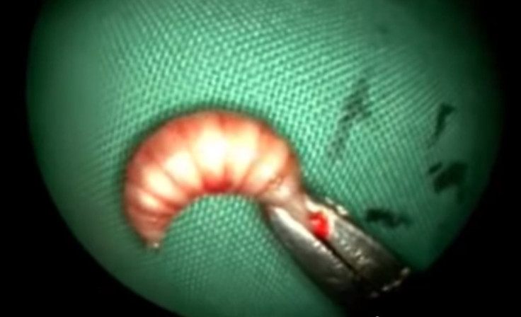 A Calming Instance Of Maggot Removal 