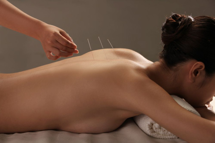 Doctor putting acupuncture needles on woman's shoulder