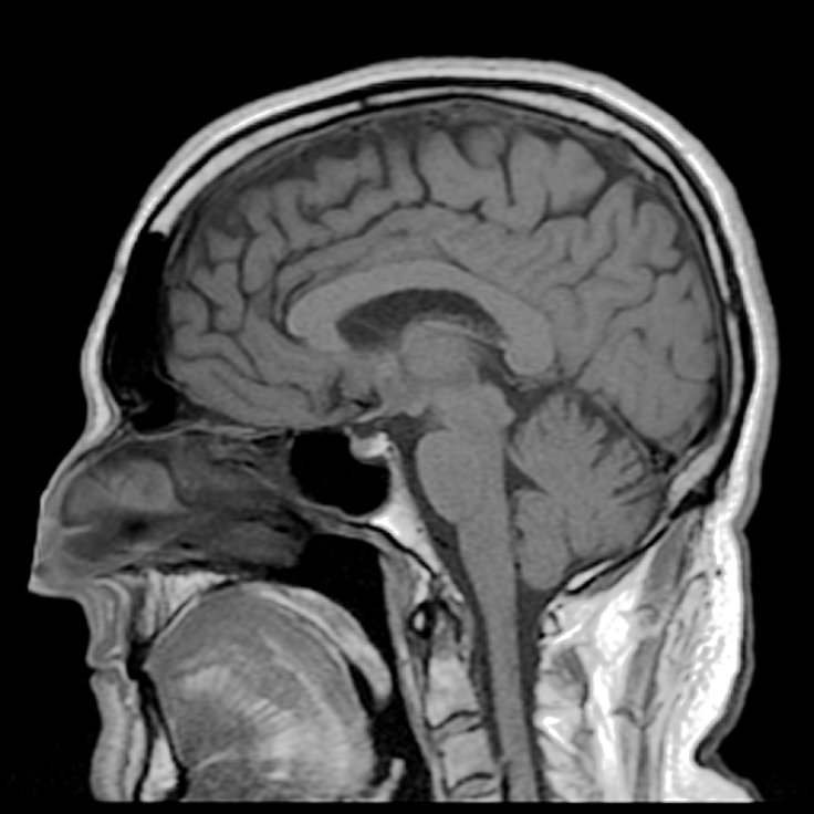 MRI brain scan