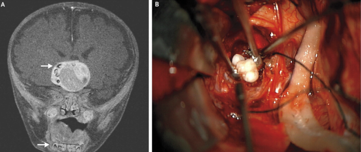 Teeth found in brain tumor