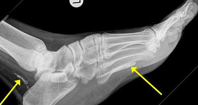 Guinea worm found in man's ankle and foot