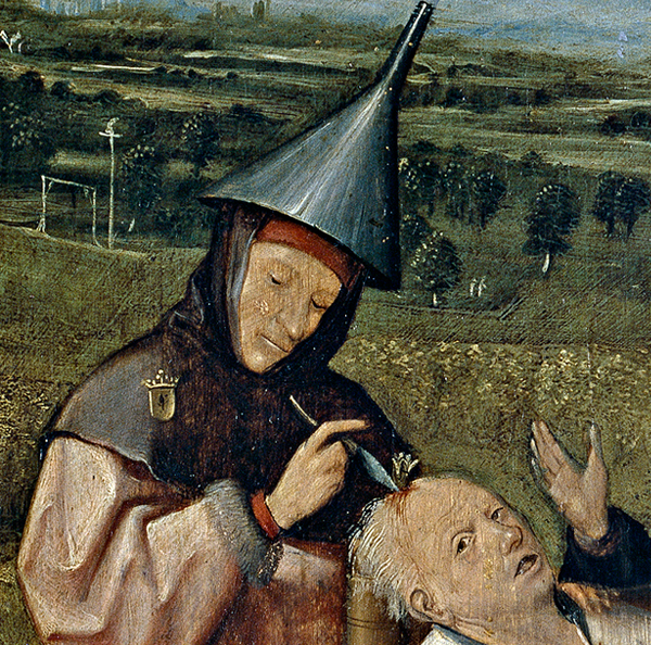 Trepanation