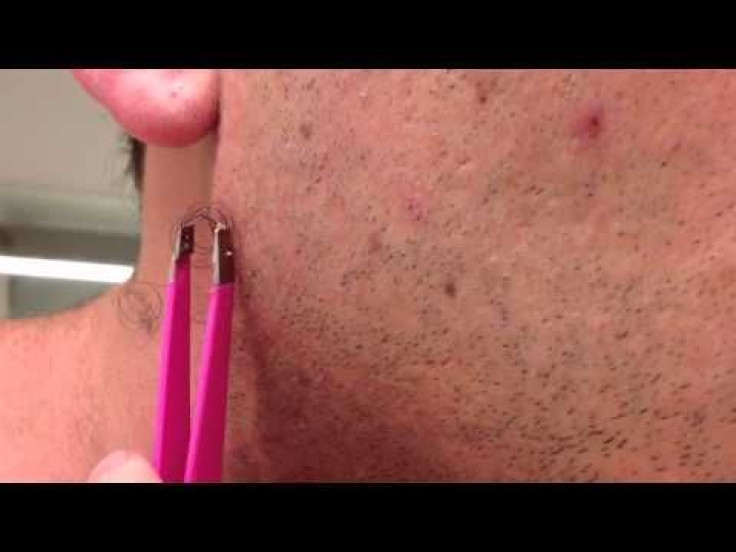 Facial Hair Tug-Of-War : Man Pulls Horrific Ingrown Hair From Jaw Line After Shaving Beard