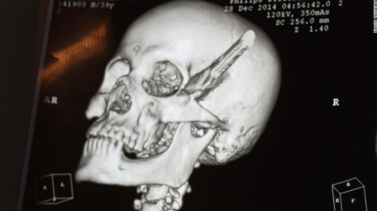 X-ray of knife lodged in skull